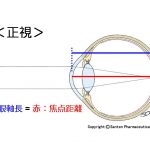 近視の進行予防の現状