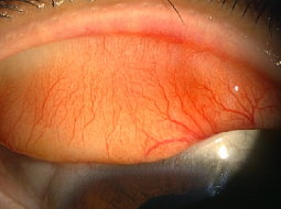片桐眼科クリニック 正常な結膜の写真