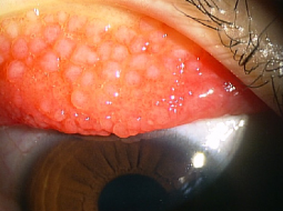 片桐眼科クリニック アレルギー性結膜炎の写真