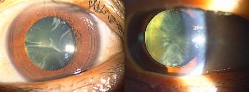 片桐眼科クリニック 白内障の写真