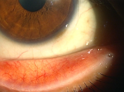 片桐眼科クリニック 正常な結膜の写真
