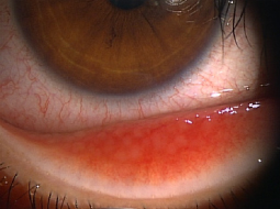 片桐眼科クリニック 結膜炎の写真