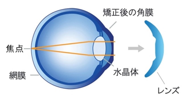 東戸塚 眼科 片桐眼科クリニック オルソケラトロジー 起床時の眼球イメージ