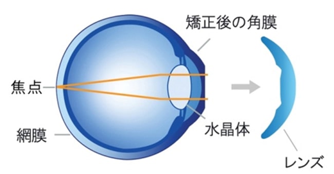 東戸塚 眼科 片桐眼科クリニック オルソケラトロジー 起床時　眼球イメージ