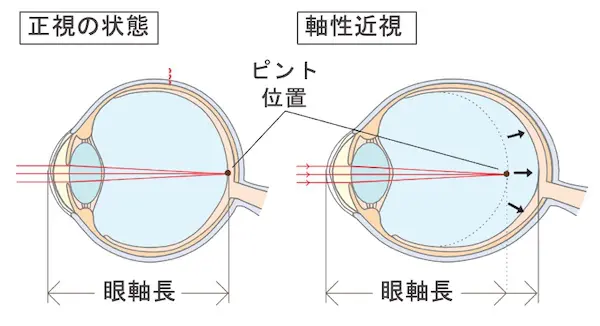眼軸長の伸びを抑えることが近視進行予防において重要