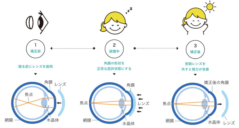 オルソケラトロジー 角膜の形状の変化