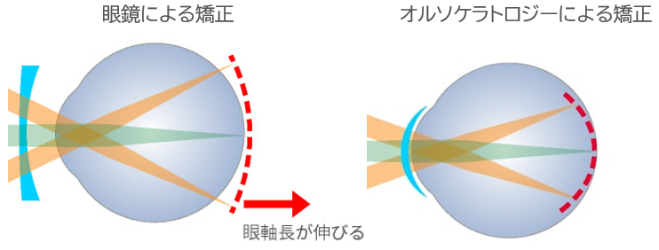 オルソケラトロジーと眼鏡による矯正の比較