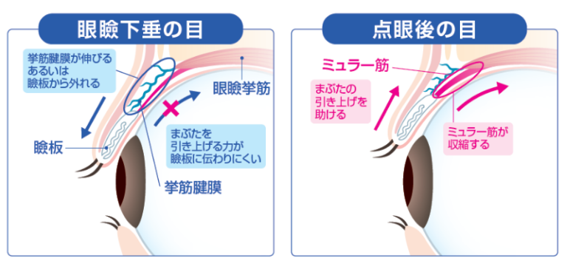 眼瞼下垂の目と眼瞼下垂の目にアップニークミニ点眼薬を点眼した後の目のイメージ