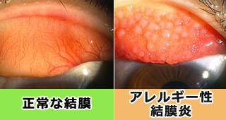 症 眼科 花粉